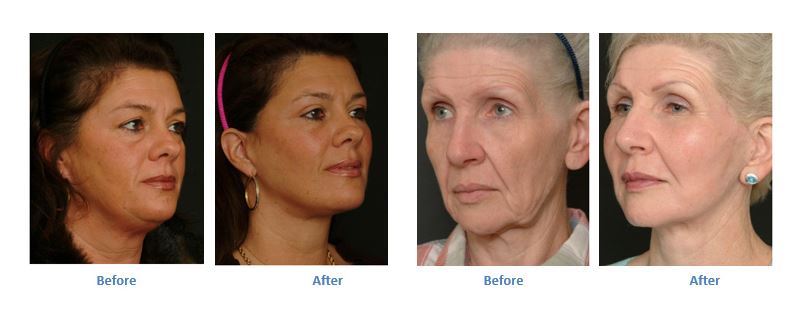 Roll Back The Years With Facelift Surgery