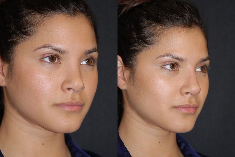 Rhinoplasty Surgeon - What Factors To Look For While Finding One ?