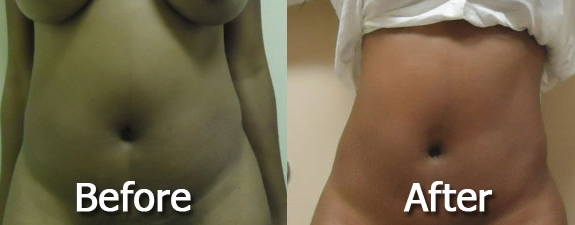 Liposuction Surgery - Tips To Get In Shape Without Workout or Dieting