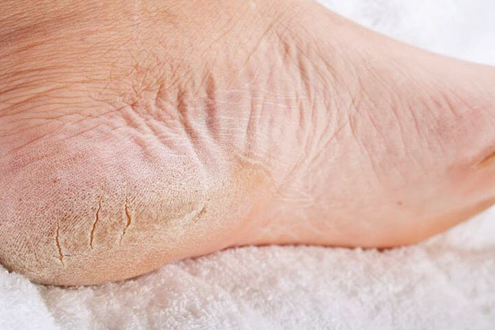 Home Remedies To Get Rid Of Cracks In Feet