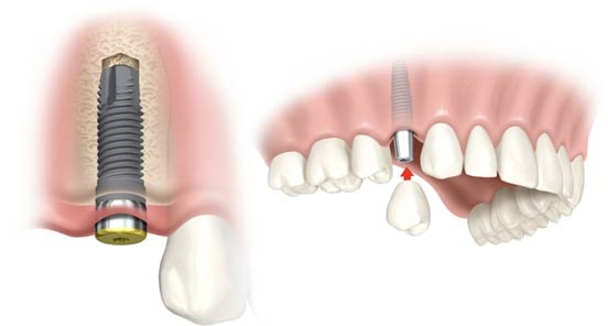 A Guide On Dental Implants For Lifetime Healthy Tooth