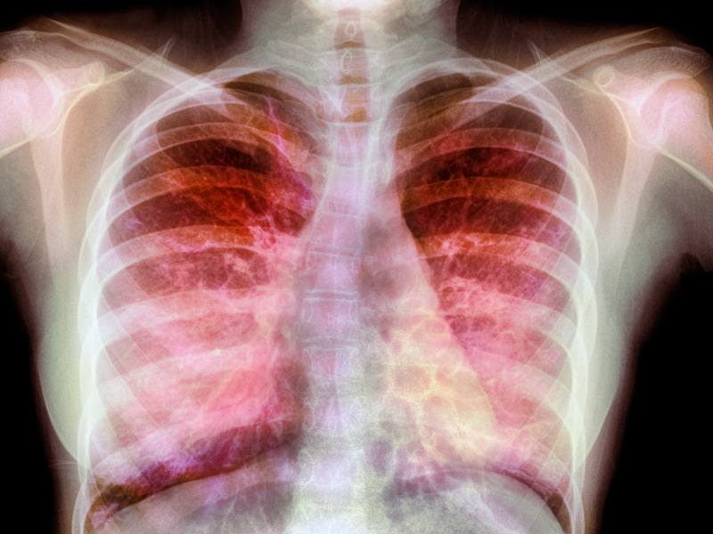 Environmental Causes Of Respiratory Diseases