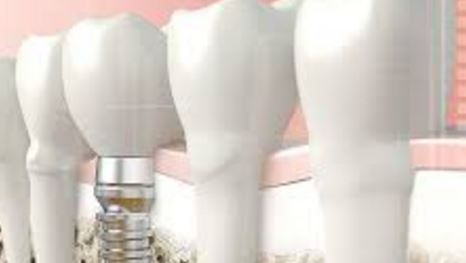 Healthful Tips To Prevent Dental Implants and Tooth Decay