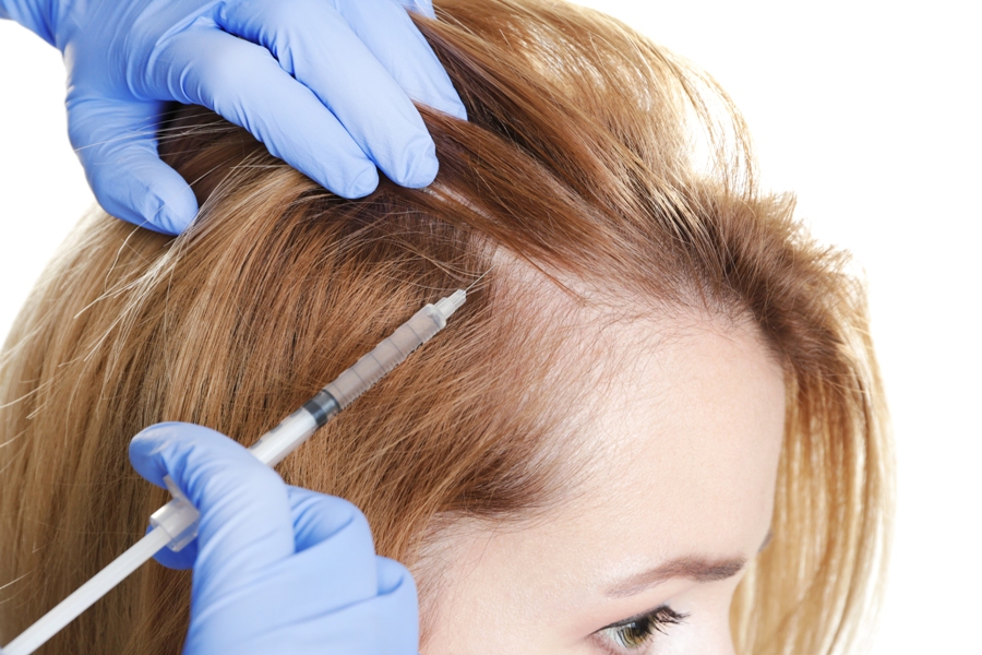 Benefits Of Microneedling For Alopecia/Rosacea Treatment In Norwood