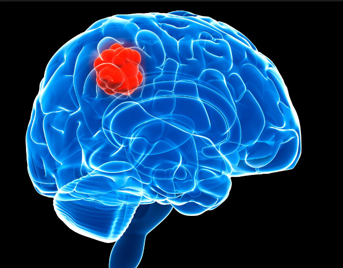 Some Important Information On Brain Tumor