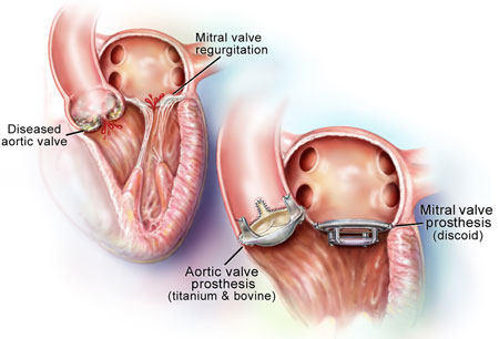 What You Need To Know About Valve Replacement Surgery