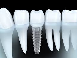 Choose The Best Dental Implant Provider In Delray Beach