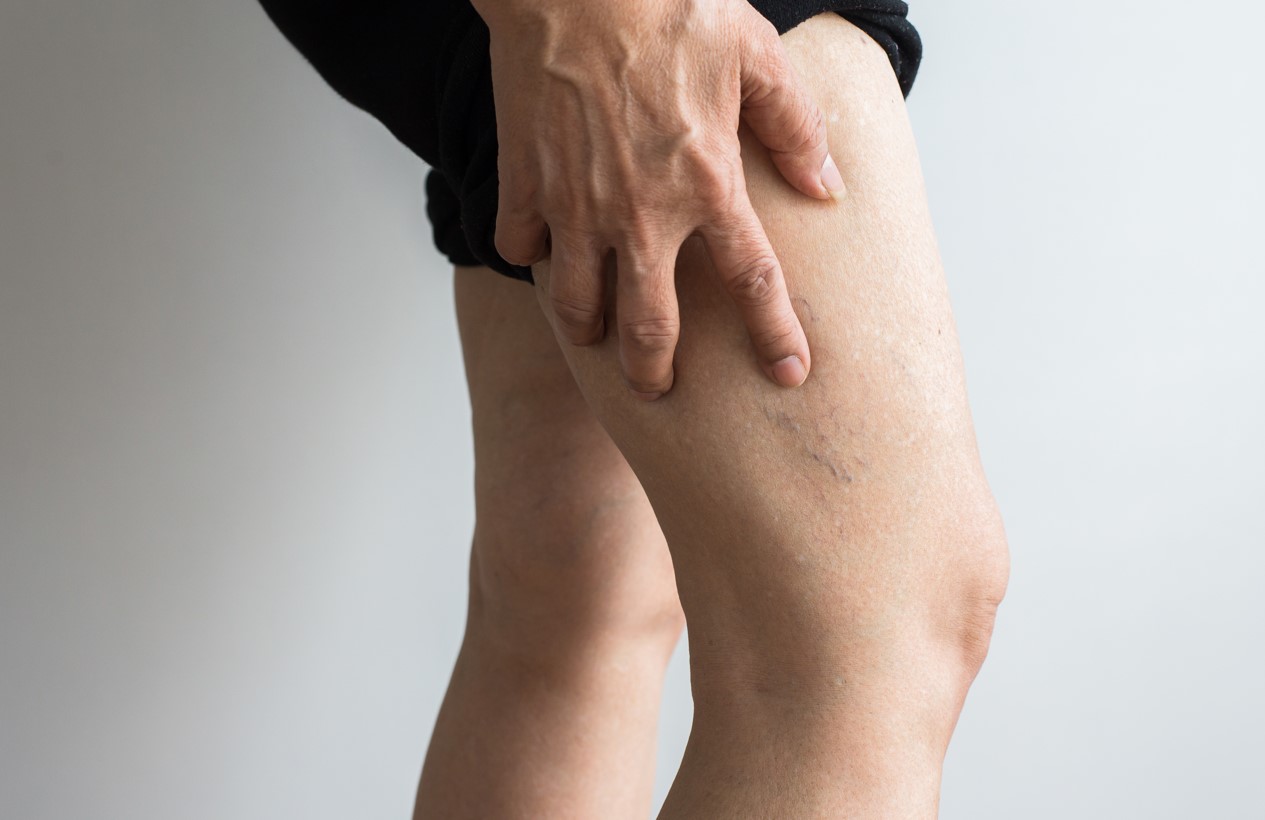Spider Veins: Causes, Symptoms, and Treatment Options for Improving Your Leg Appearance